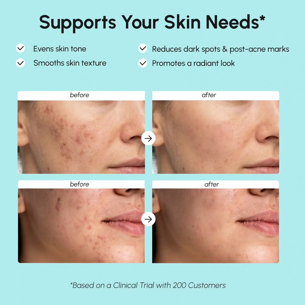 Marée® Azelaic Acid Cream soothing sensitive skin while reducing blemishes and redness
